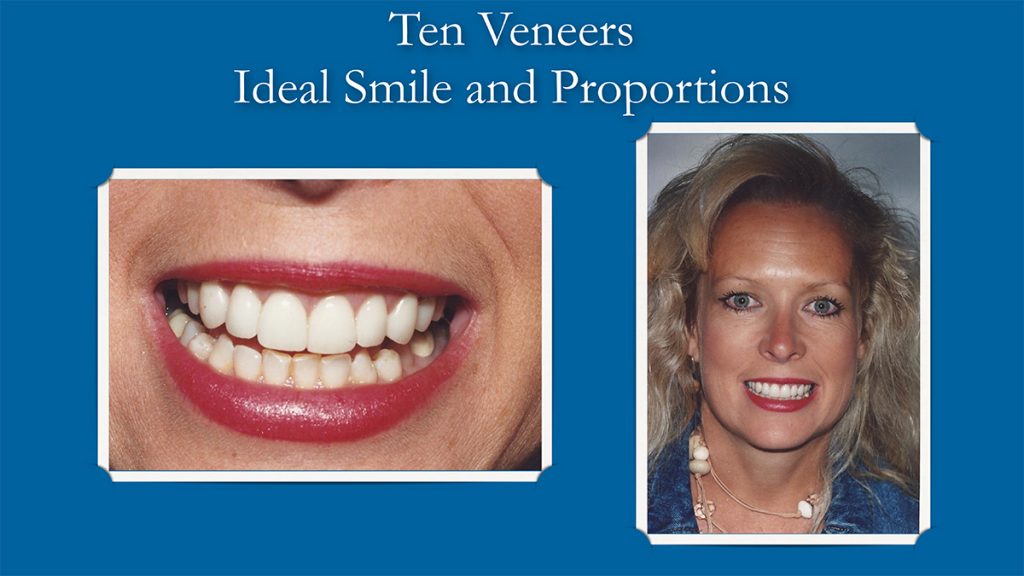 Smile Gallery Patient Before & After Photos Tracy